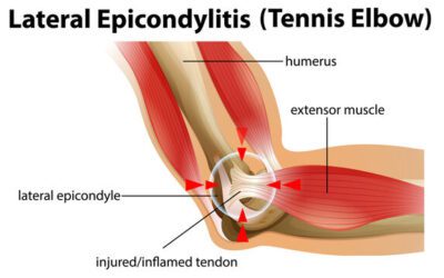 How to treat lateral epicondyalgia