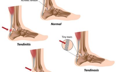 Physiotherapy for Achilles Tendinopathy