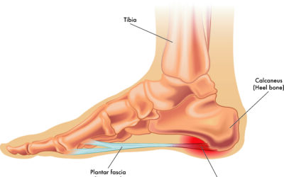 PLANTAR HEEL PAIN (PLANTAR FASCIITIS) AND PHYSIOTHERAPY TREATMENT